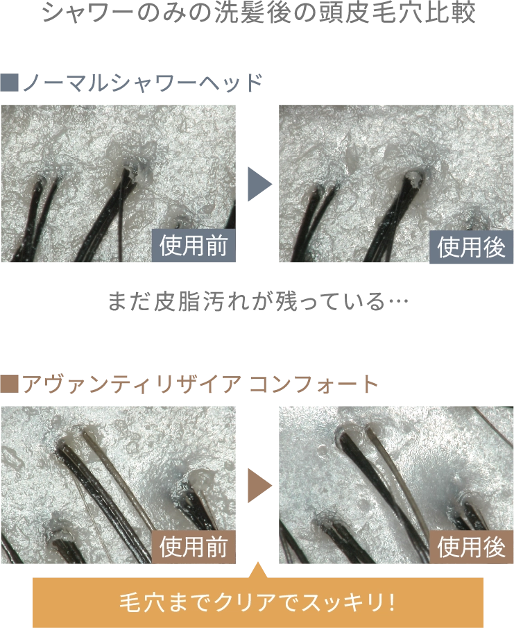 シャワーのみの洗髪後の頭皮毛穴比較